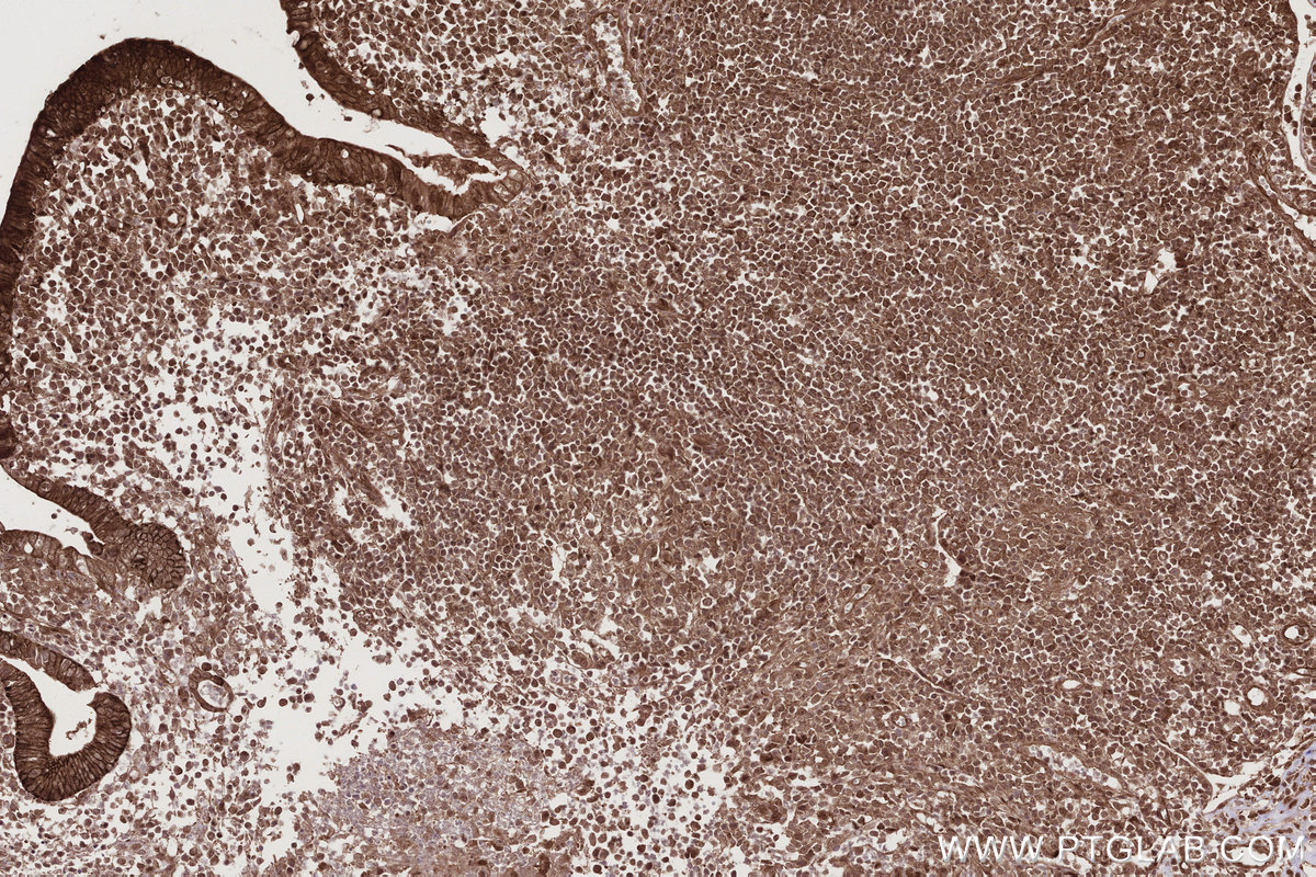 Immunohistochemical analysis of paraffin-embedded human appendicitis tissue slide using KHC2781 (BIRC7 IHC Kit).