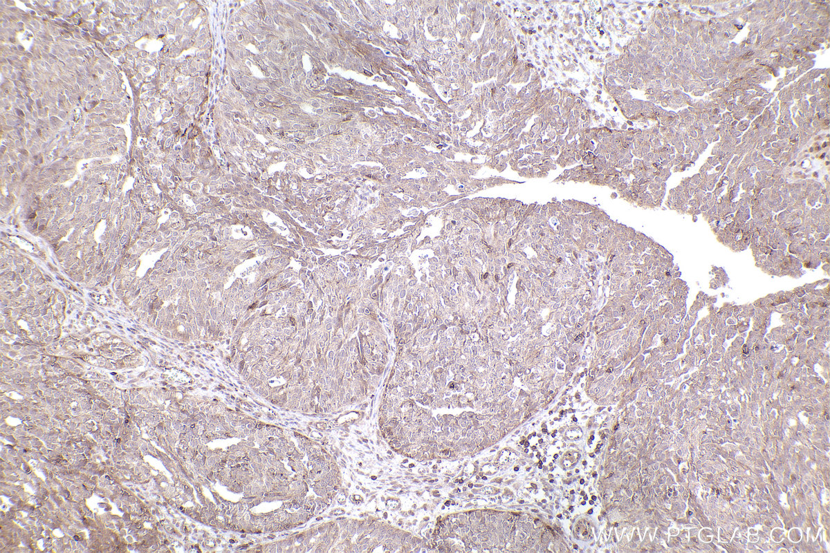 Immunohistochemical analysis of paraffin-embedded human ovary cancer tissue slide using KHC2413 (BNIP2 IHC Kit).