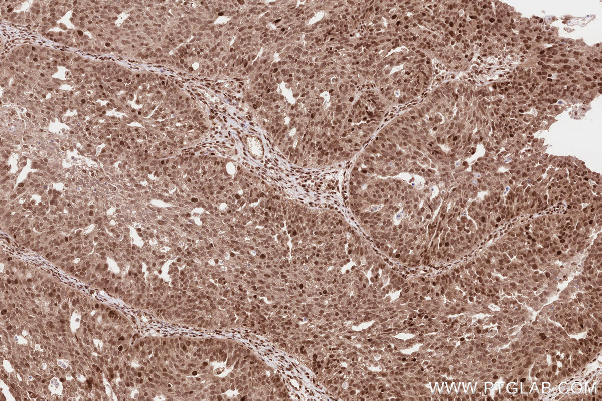 Immunohistochemical analysis of paraffin-embedded human ovary cancer tissue slide using KHC2592 (BRAT1 IHC Kit).