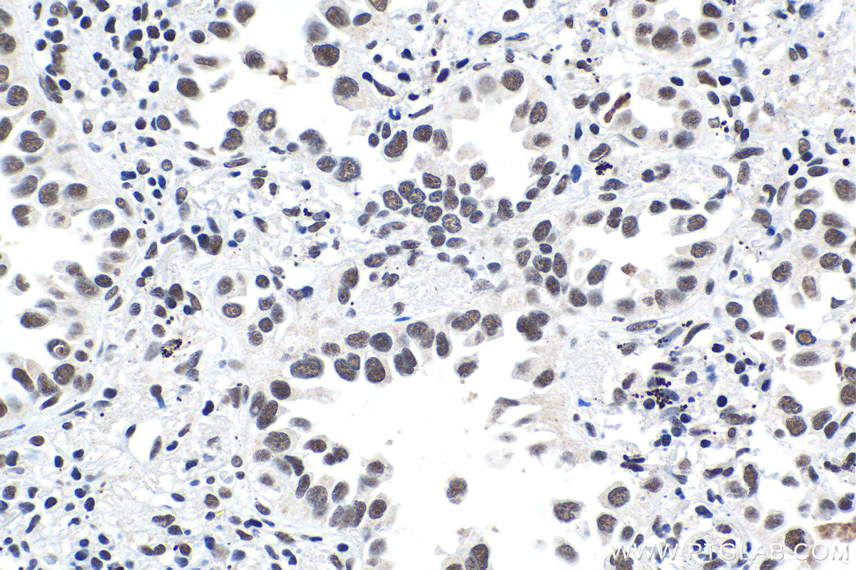 Immunohistochemical analysis of paraffin-embedded human lung cancer tissue slide using KHC1470 (BRD4 IHC Kit).