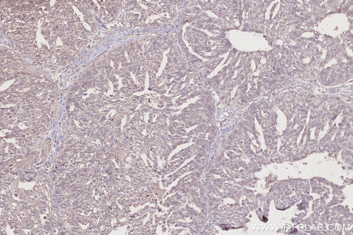 Immunohistochemical analysis of paraffin-embedded human ovary cancer tissue slide using KHC2733 (BRK1/C3orf10 IHC Kit).