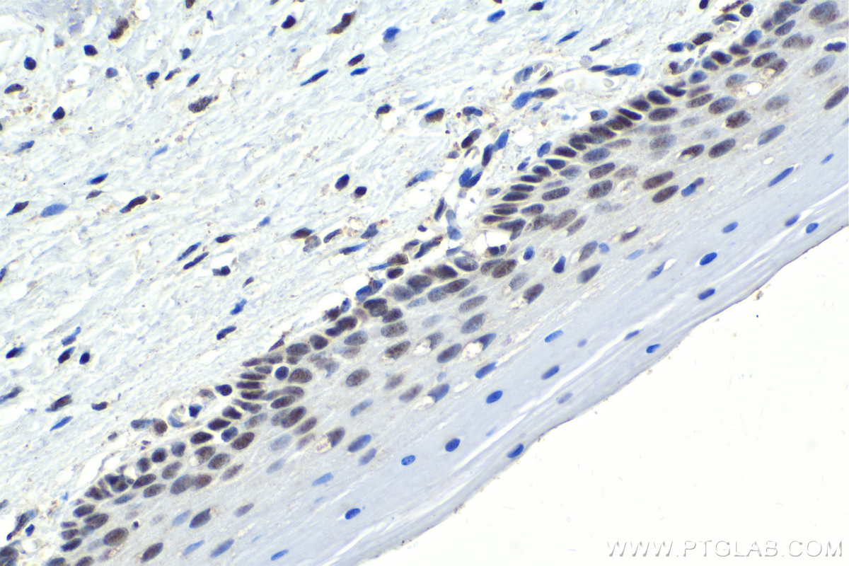 Immunohistochemical analysis of paraffin-embedded human cervical cancer tissue slide using KHC1777 (BRMS1L IHC Kit).