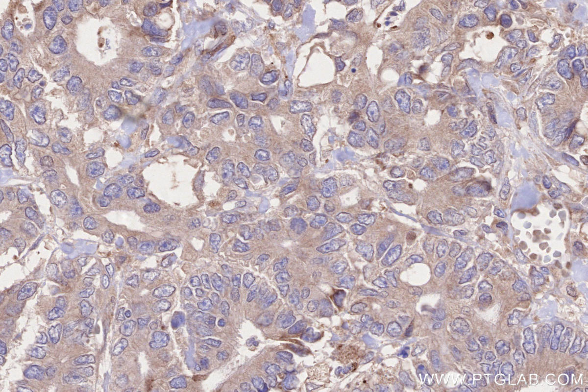 Immunohistochemical analysis of paraffin-embedded human rectal cancer tissue slide using KHC2652 (BRSK2 IHC Kit).