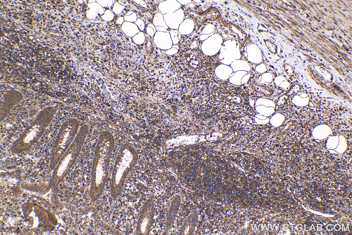 Immunohistochemical analysis of paraffin-embedded human appendicitis tissue slide using KHC1677 (BTK IHC Kit).