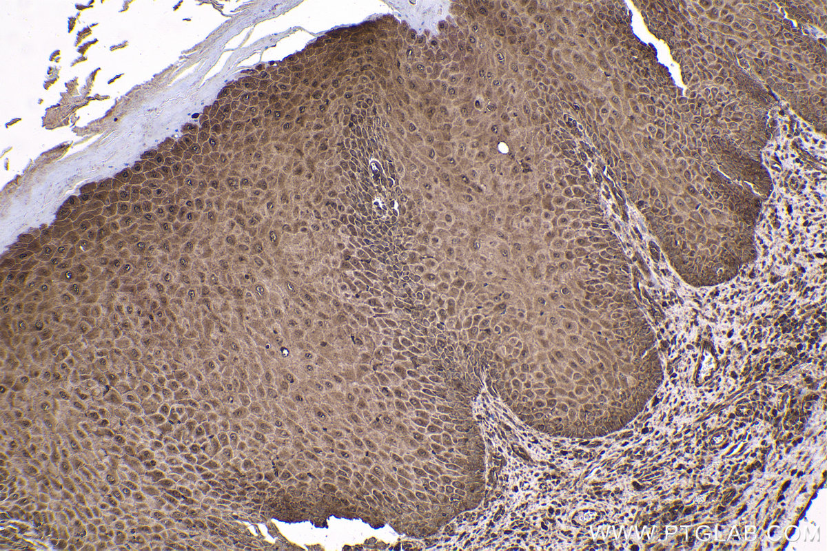 Immunohistochemical analysis of paraffin-embedded human skin cancer tissue slide using KHC1677 (BTK IHC Kit).