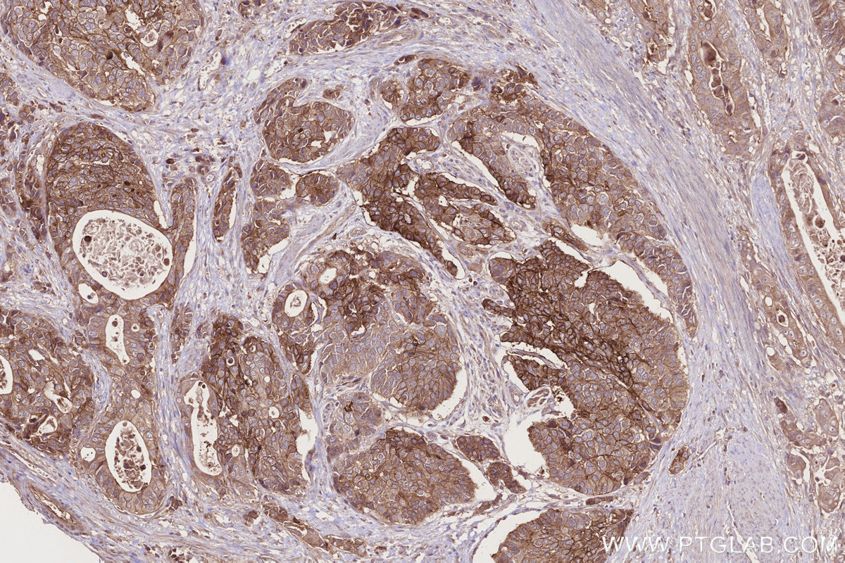 Immunohistochemical analysis of paraffin-embedded human stomach cancer tissue slide using KHC2737 (BTN2A2 IHC Kit).