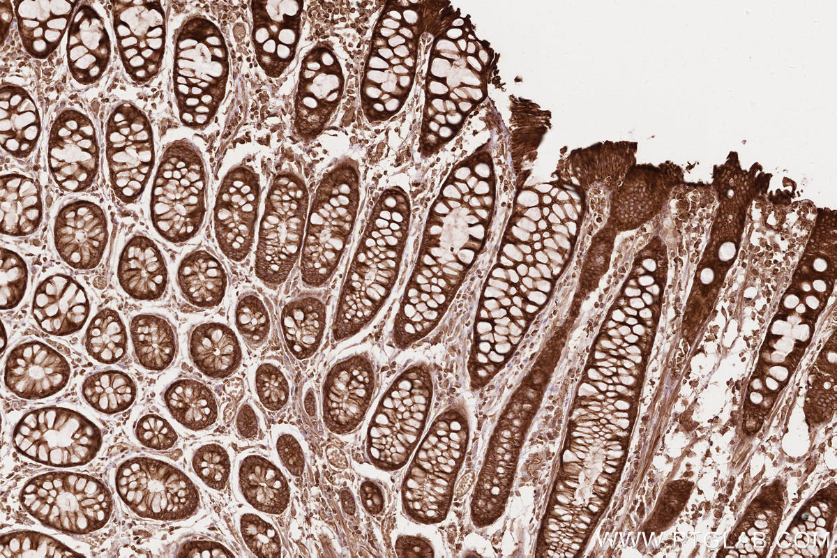 Immunohistochemical analysis of paraffin-embedded human rectal cancer tissue slide using KHC2612 (BZW1 IHC Kit).