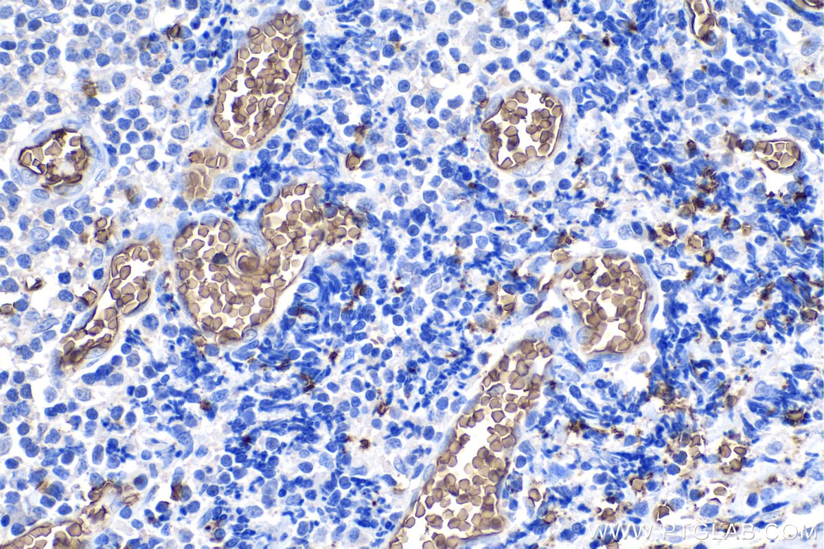 Immunohistochemical analysis of paraffin-embedded human tonsillitis tissue slide using KHC0200 (band 3/ AE1 IHC Kit).