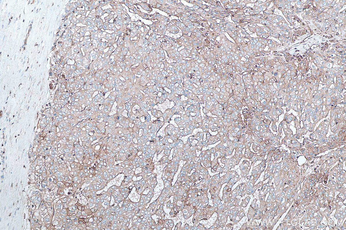 Immunohistochemical analysis of paraffin-embedded human liver cancer tissue slide using KHC0078 (Beta-2-Microglobulin IHC Kit).