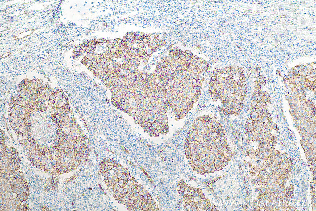 Immunohistochemical analysis of paraffin-embedded human breast cancer tissue slide using KHC0008 (Beta Catenin IHC Kit)
