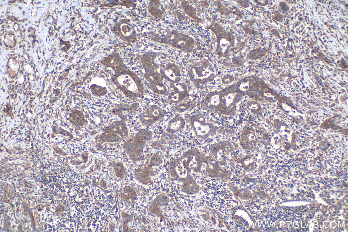 Immunohistochemical analysis of paraffin-embedded human lung cancer tissue slide using KHC1196 (Bif-1 IHC Kit).
