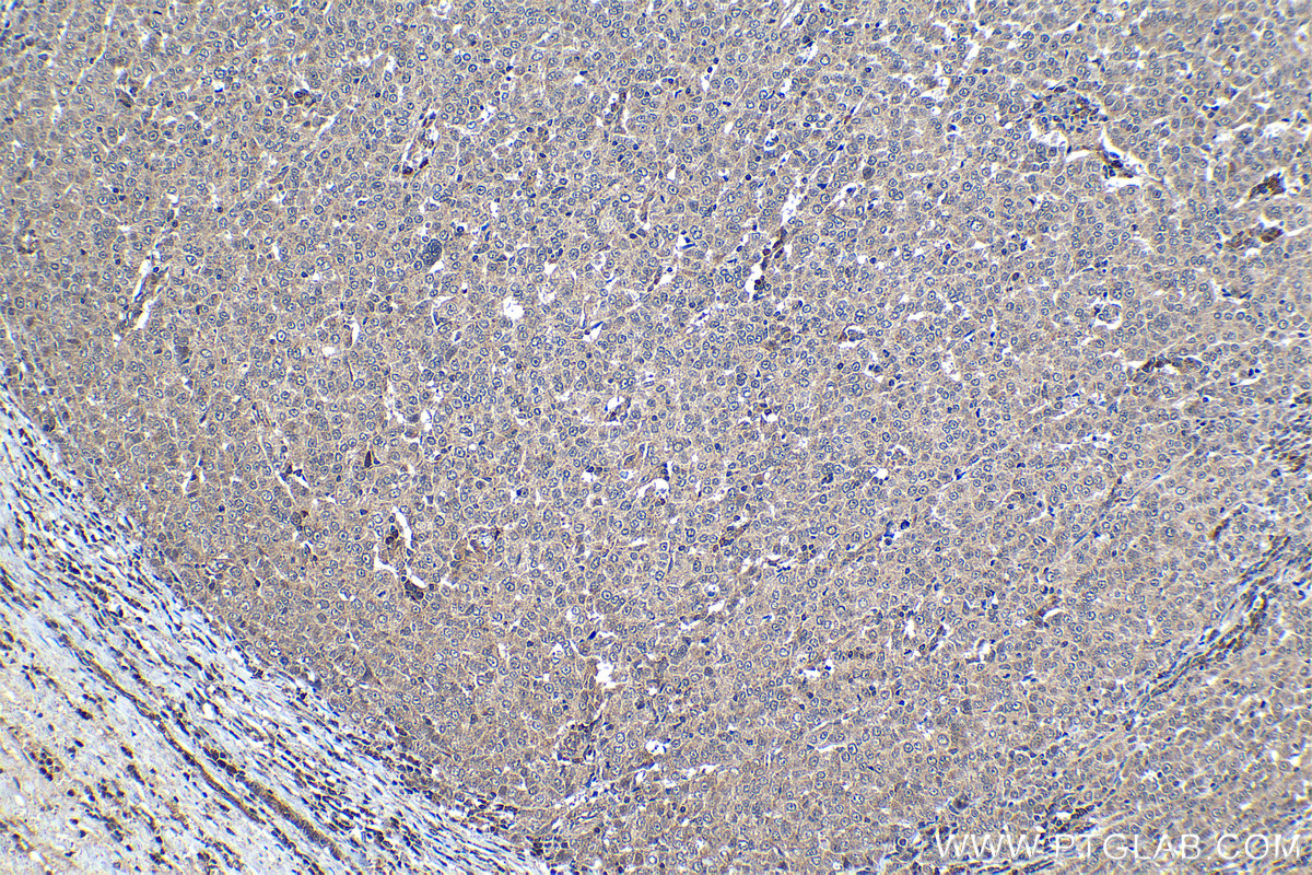 Immunohistochemical analysis of paraffin-embedded human ovary tumor tissue slide using KHC1295 (C18orf21 IHC Kit).