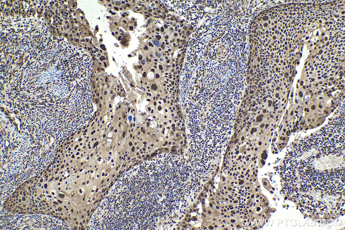 Immunohistochemical analysis of paraffin-embedded human cervical cancer tissue slide using KHC1722 (C1D IHC Kit).