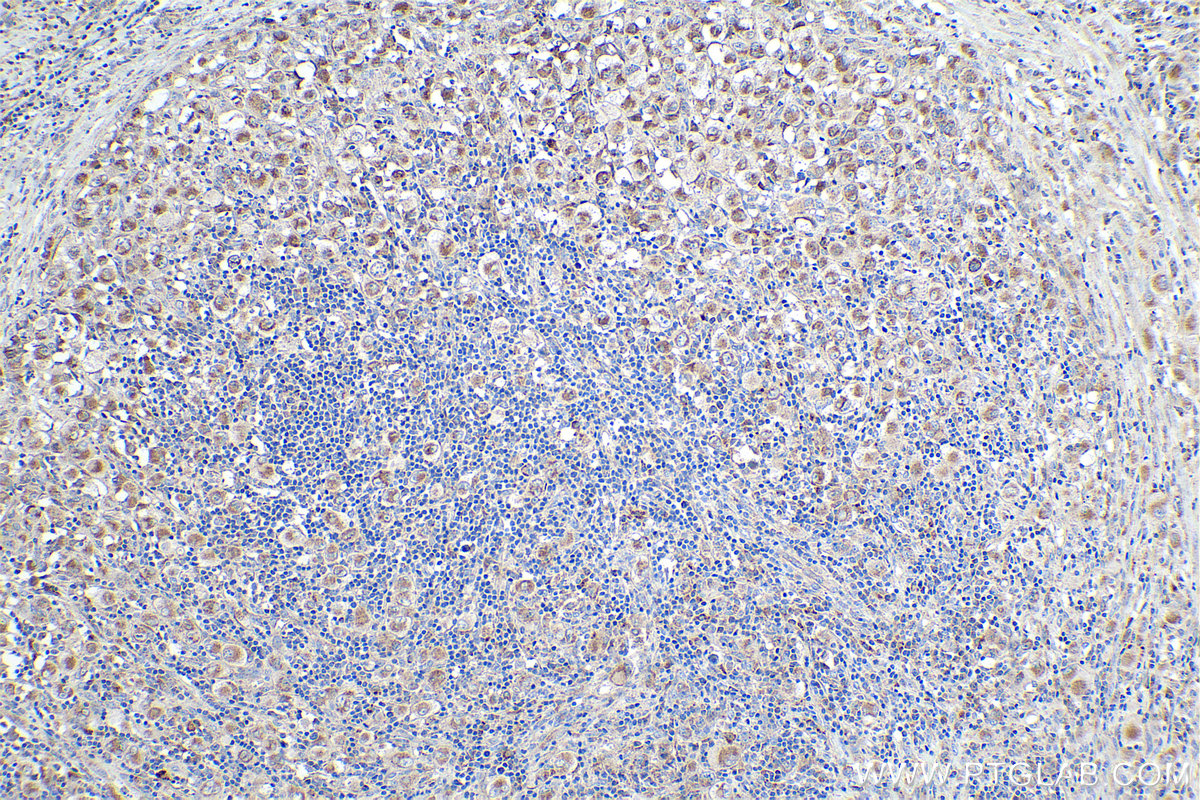 Immunohistochemical analysis of paraffin-embedded human lymphoma tissue slide using KHC0372 (C1QC IHC Kit).