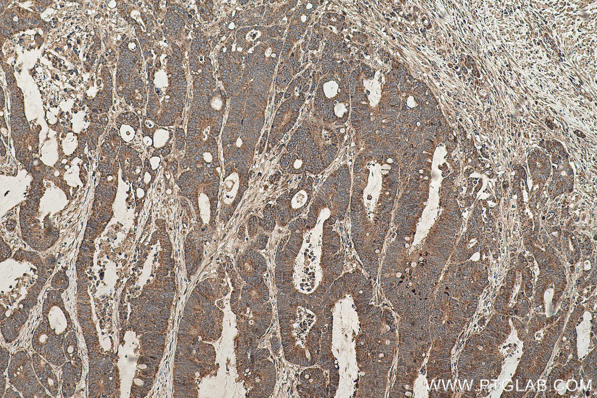 Immunohistochemical analysis of paraffin-embedded human colon cancer tissue slide using KHC0599 (SLC52A3 IHC Kit).