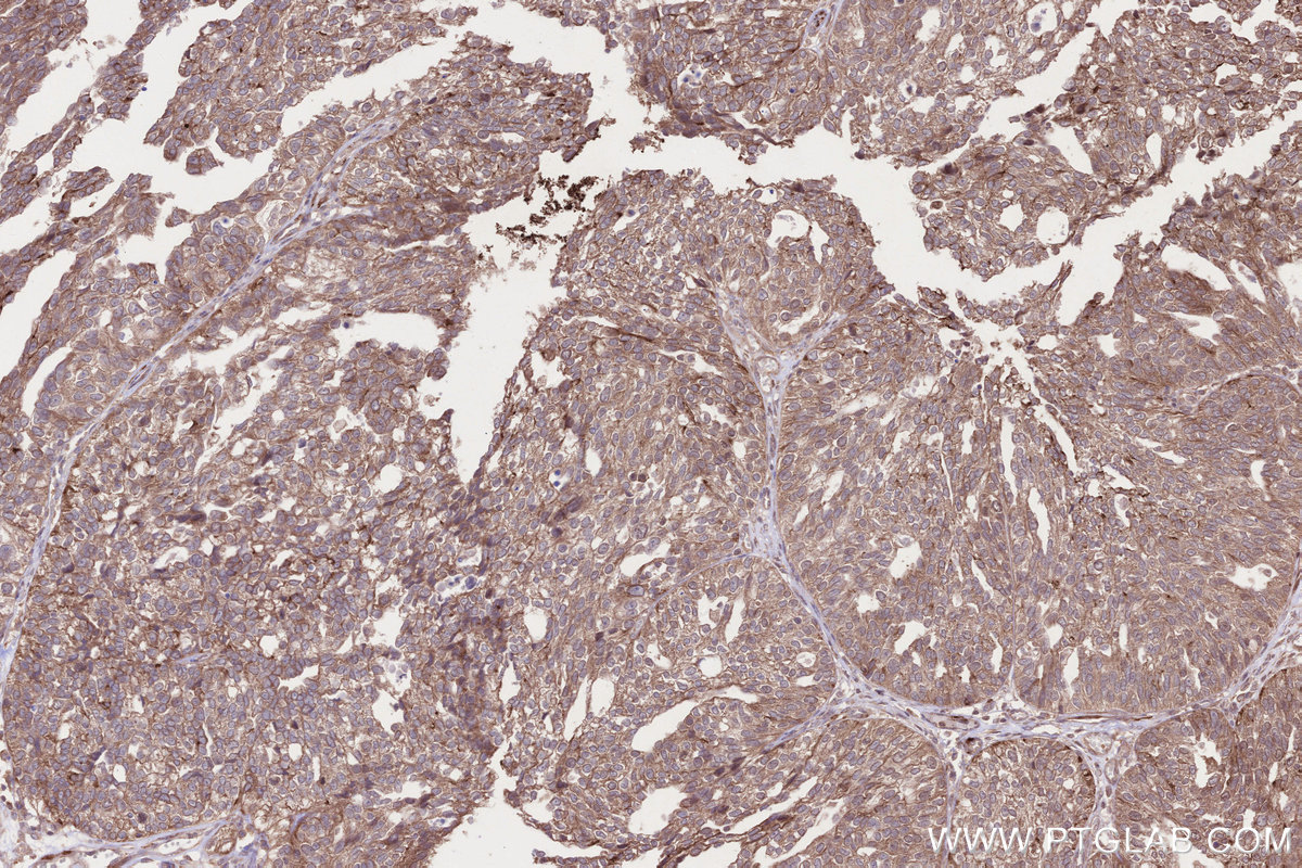 Immunohistochemical analysis of paraffin-embedded human ovary cancer tissue slide using KHC2641 (C2CD5 IHC Kit).