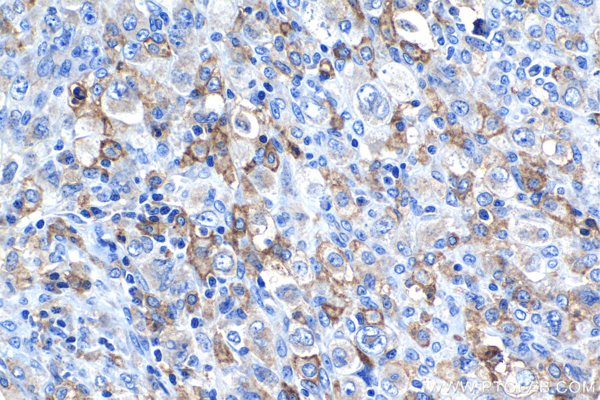 Immunohistochemical analysis of paraffin-embedded human lymphoma tissue slide using KHC1293 (C5AR1 IHC Kit).