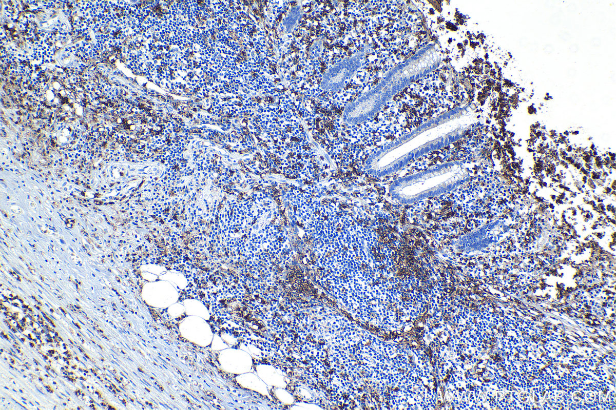 Immunohistochemical analysis of paraffin-embedded human appendicitis tissue slide using KHC1293 (C5AR1 IHC Kit).