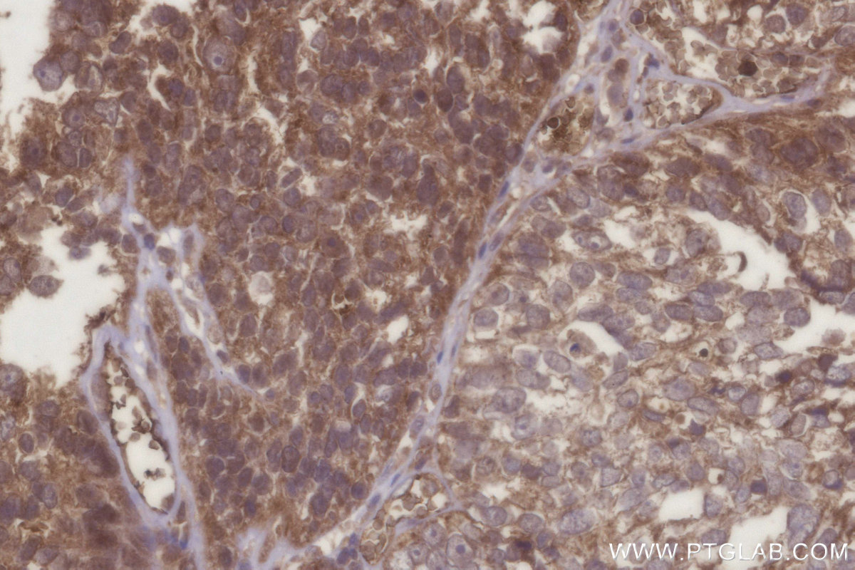 Immunohistochemical analysis of paraffin-embedded human ovary cancer tissue slide using KHC2945 (C8orf4 IHC Kit).