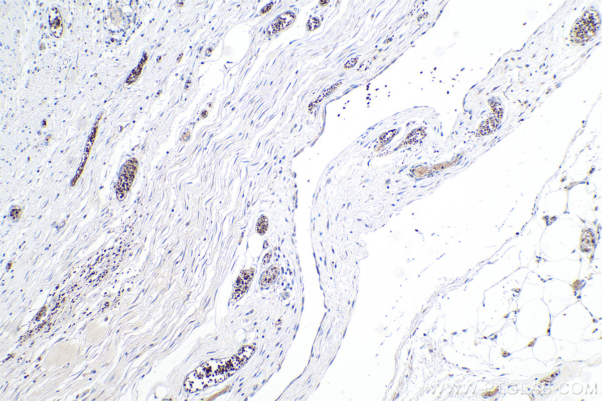 Immunohistochemical analysis of paraffin-embedded human colon cancer tissue slide using KHC0551 (CA1 IHC Kit).