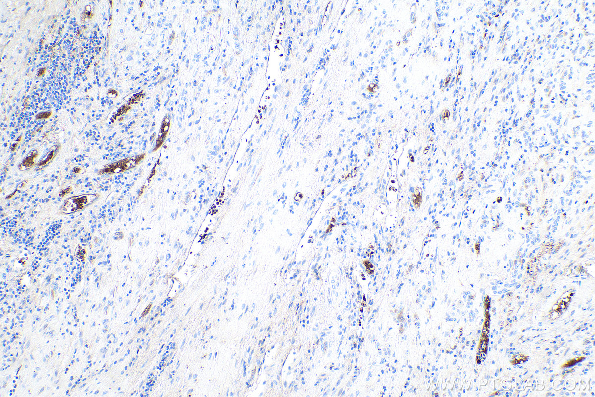 Immunohistochemical analysis of paraffin-embedded human liver cancer tissue slide using KHC0551 (CA1 IHC Kit).