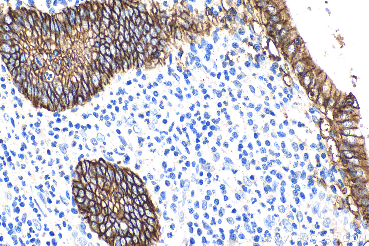 Immunohistochemical analysis of paraffin-embedded human appendicitis tissue slide using KHC2088 (CA12 IHC Kit).