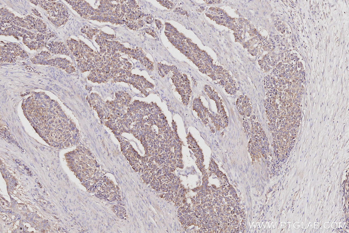 Immunohistochemical analysis of paraffin-embedded human stomach cancer tissue slide using KHC3050 (CAMK2A IHC Kit). Immunohistochemical analysis of paraffin-embedded human stomach cancer tissue slide using KHC3050 (CAMK2A IHC Kit).