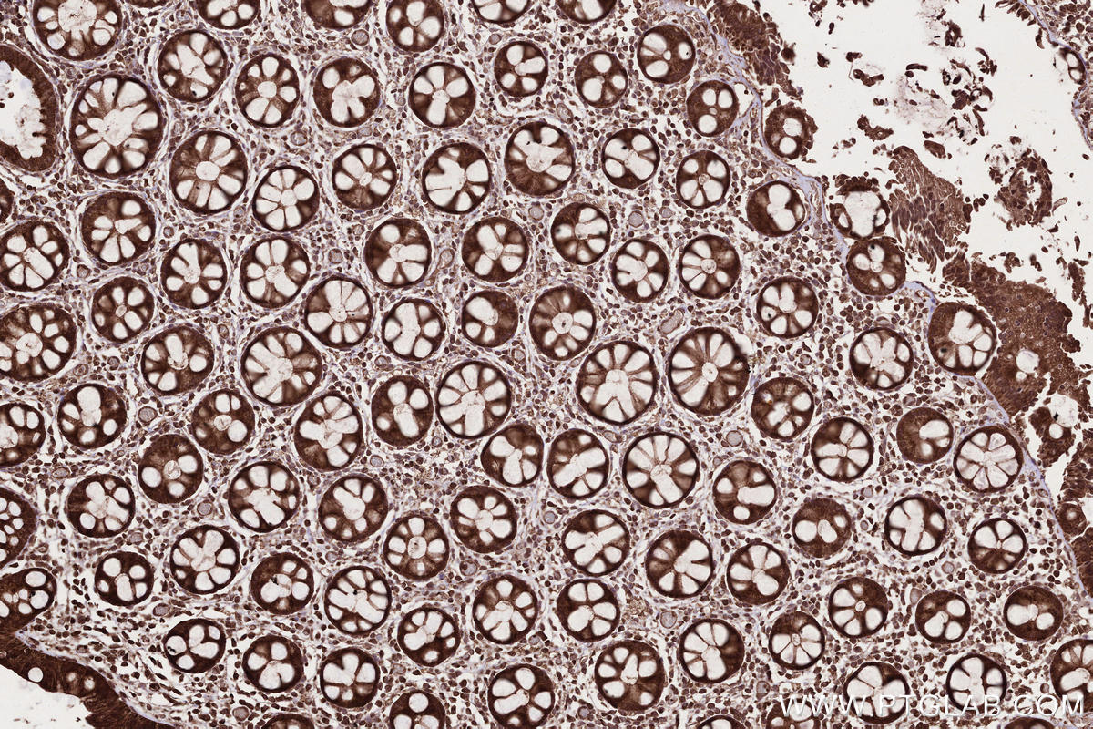 Immunohistochemical analysis of paraffin-embedded human rectal cancer tissue slide using KHC2677 (CAMKK1 IHC Kit).