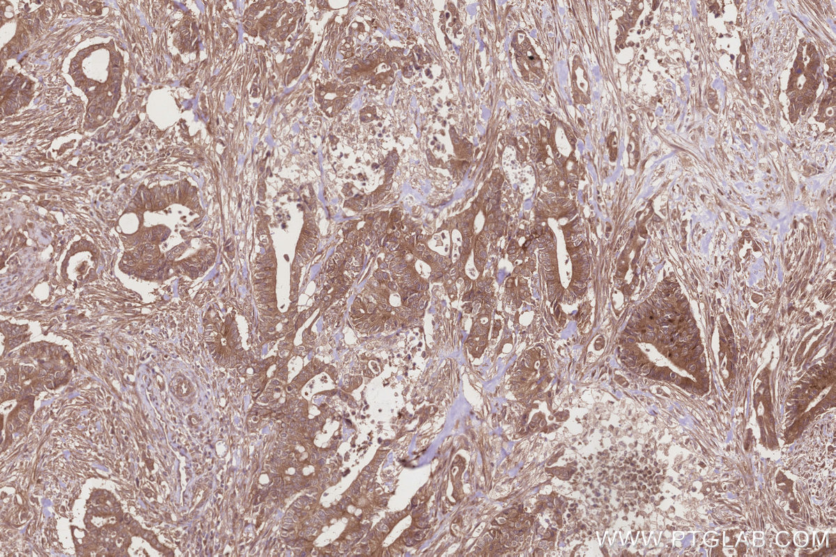 Immunohistochemical analysis of paraffin-embedded human rectal cancer tissue slide using KHC2827 (CAMKK2 IHC Kit).