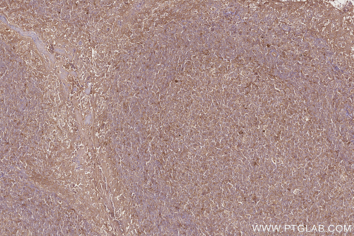 Immunohistochemical analysis of paraffin-embedded human tonsillitis tissue slide using KHC2827 (CAMKK2 IHC Kit).