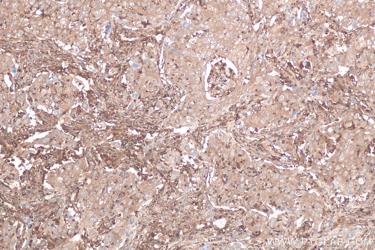 Immunohistochemical analysis of paraffin-embedded human lung cancer tissue slide using KHC0835 (CAP1 IHC Kit).