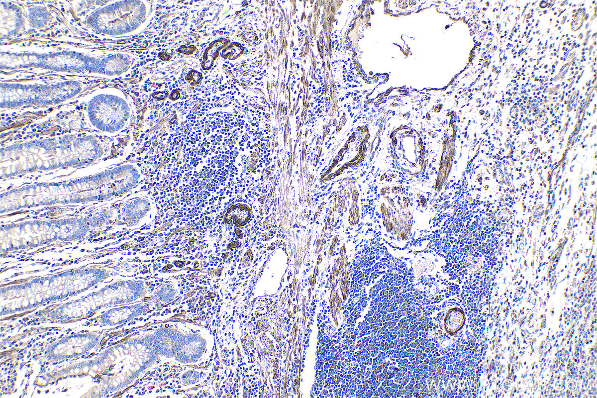 Immunohistochemical analysis of paraffin-embedded human stomach cancer tissue slide using KHC0969 (CAP2 IHC Kit).