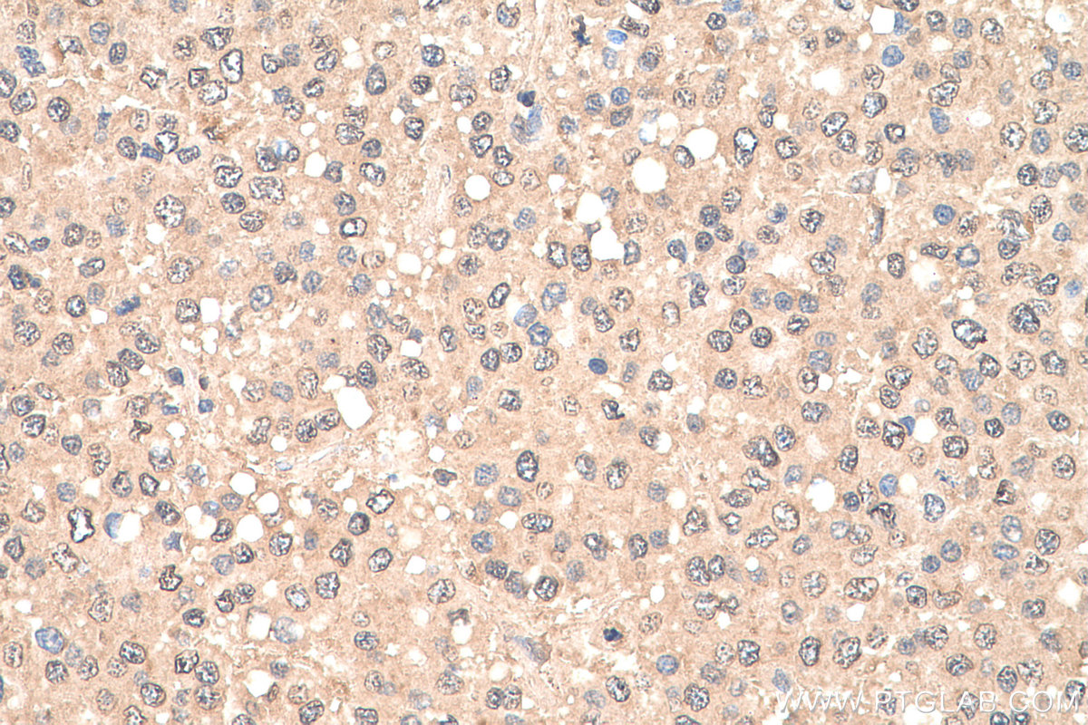 Immunohistochemical analysis of paraffin-embedded human liver cancer tissue slide using KHC0709 (CAPG IHC Kit).