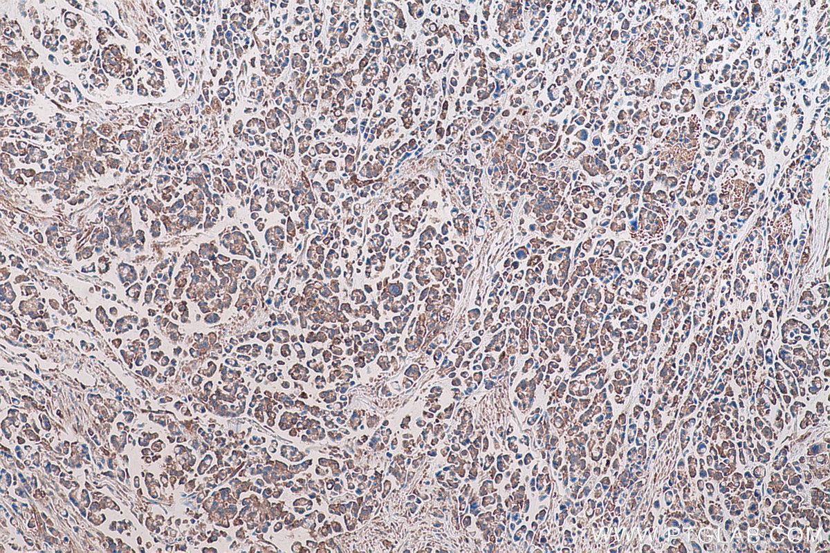 Immunohistochemical analysis of paraffin-embedded human colon cancer tissue slide using KHC0724 (CAPN2 IHC Kit).