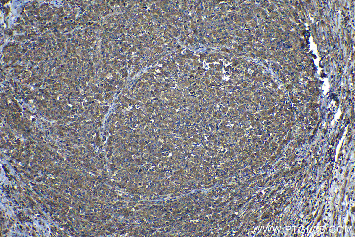 Immunohistochemical analysis of paraffin-embedded human lymphoma tissue slide using KHC1312 (CASP8 IHC Kit).