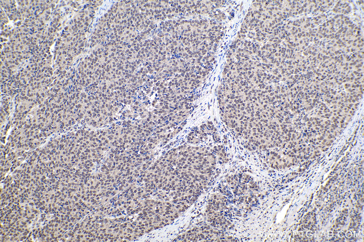 Immunohistochemical analysis of paraffin-embedded human stomach cancer tissue slide using KHC0920 (CBX1 IHC Kit).