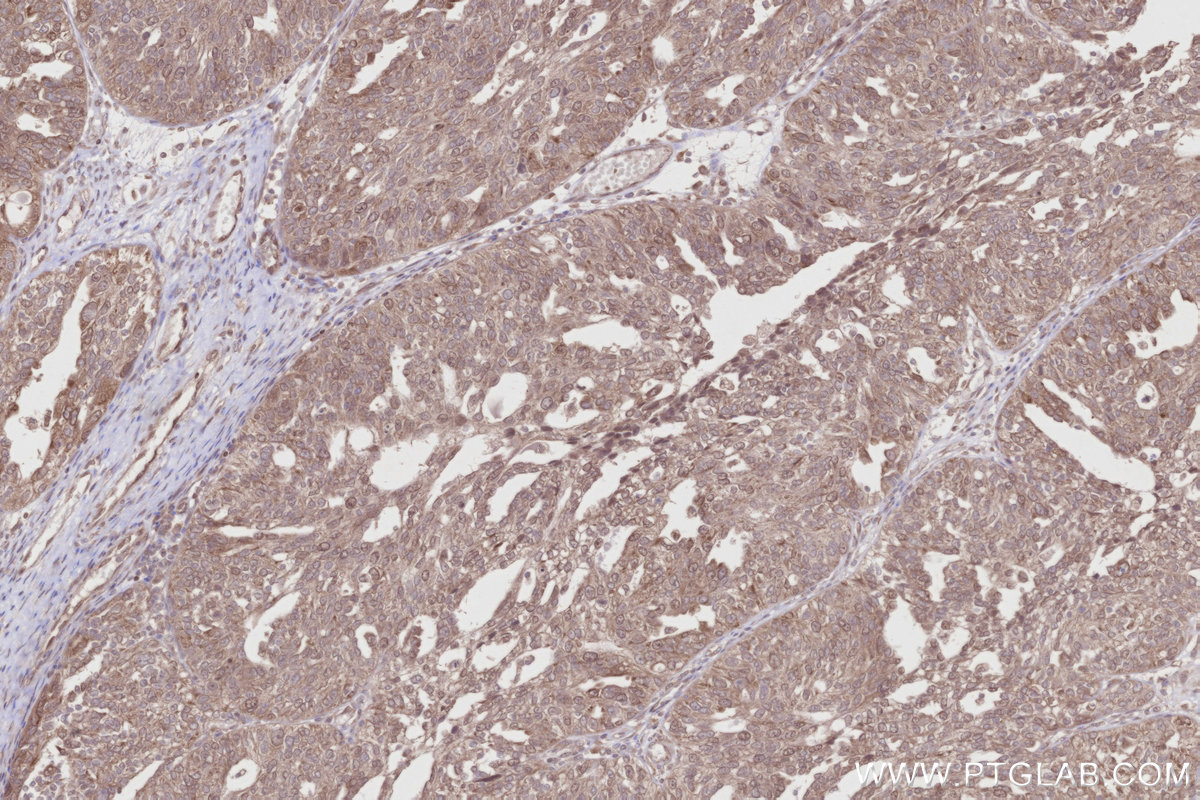 Immunohistochemical analysis of paraffin-embedded human ovary cancer tissue slide using KHC2810 (CCDC115 IHC Kit).