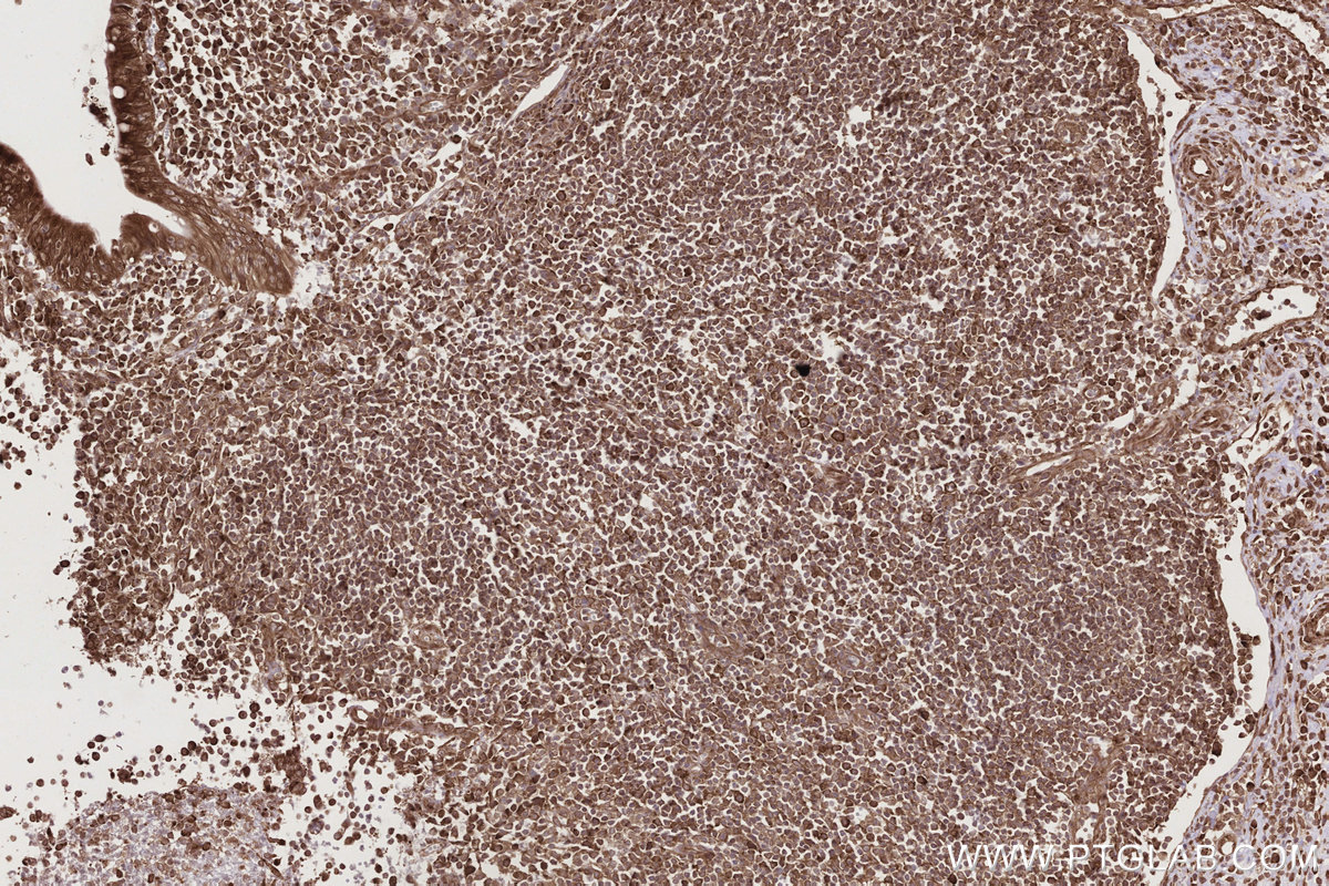 Immunohistochemical analysis of paraffin-embedded human appendicitis tissue slide using KHC2784 (CCDC124 IHC Kit).