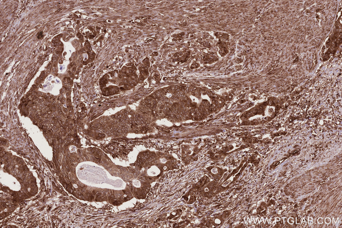 Immunohistochemical analysis of paraffin-embedded human stomach cancer tissue slide using KHC2784 (CCDC124 IHC Kit).