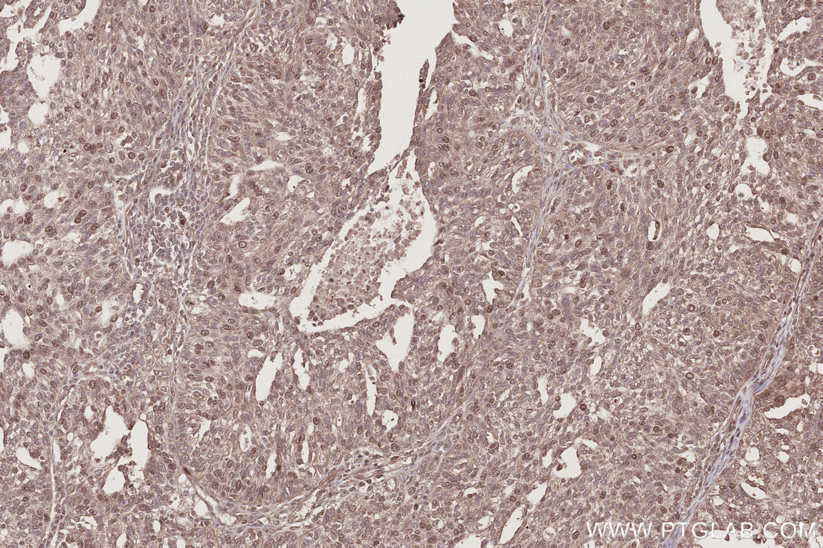 Immunohistochemical analysis of paraffin-embedded human ovary cancer tissue slide using KHC2787 (CCDC99 IHC Kit).