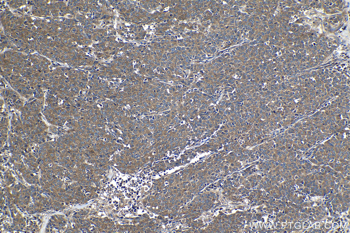 Immunohistochemical analysis of paraffin-embedded human stomach cancer tissue slide using KHC1174 (CCM3/PDCD10 IHC Kit).