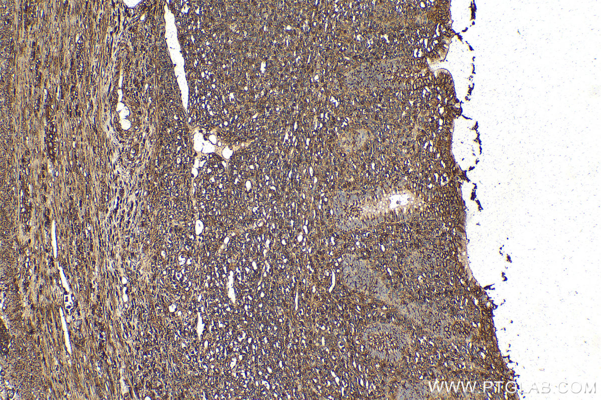 Immunohistochemical analysis of paraffin-embedded human appendicitis tissue slide using KHC2132 (CCNB2 IHC Kit).