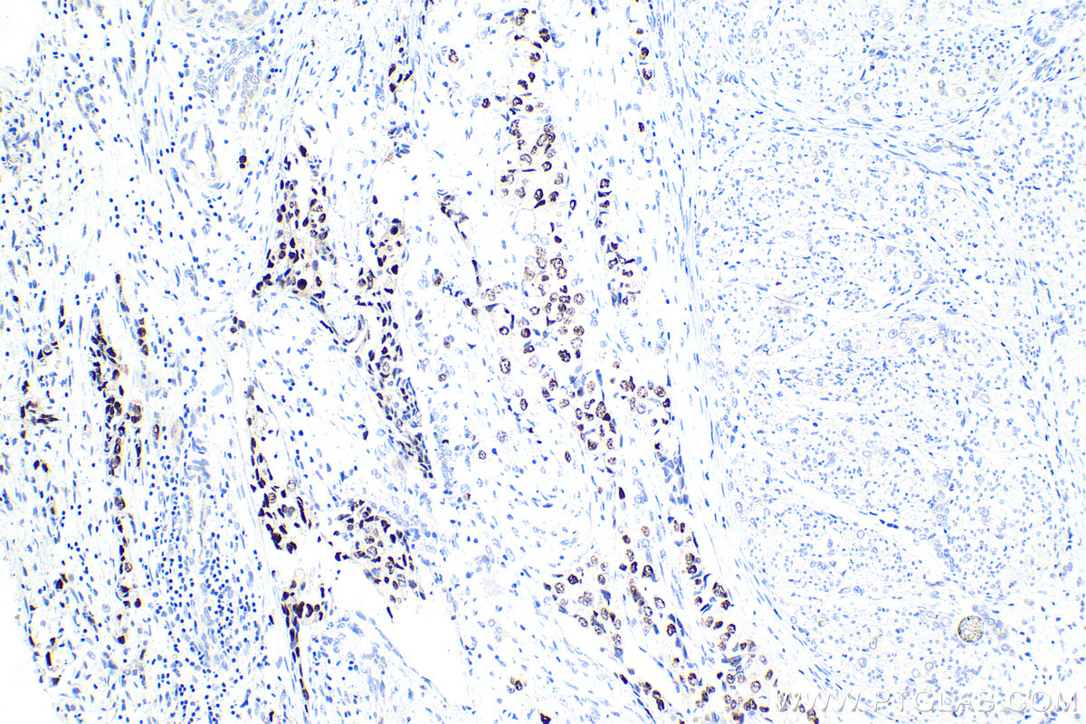 Immunohistochemical analysis of paraffin-embedded human urothelial carcinoma tissue slide using KHC1605 (CCND3 IHC Kit).
