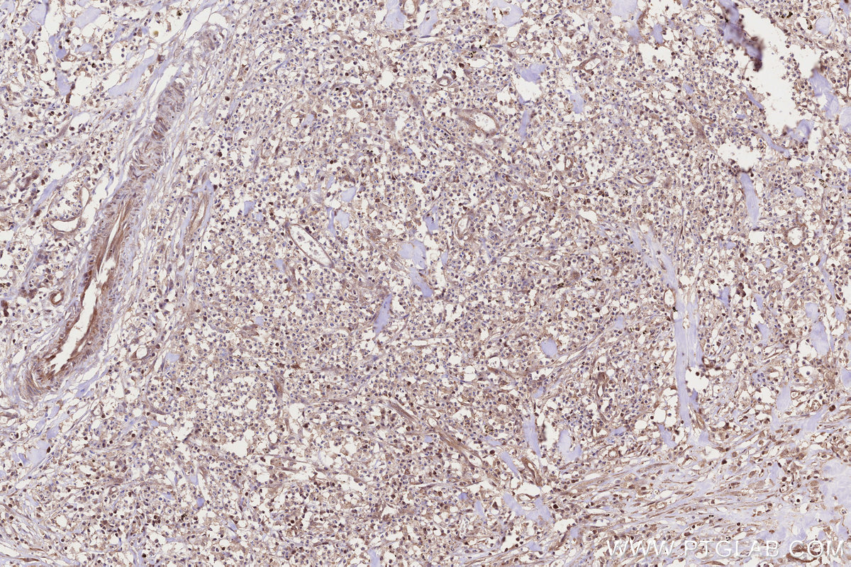 Immunohistochemical analysis of paraffin-embedded human colon cancer tissue slide using KHC3222 (CCT4 IHC Kit).