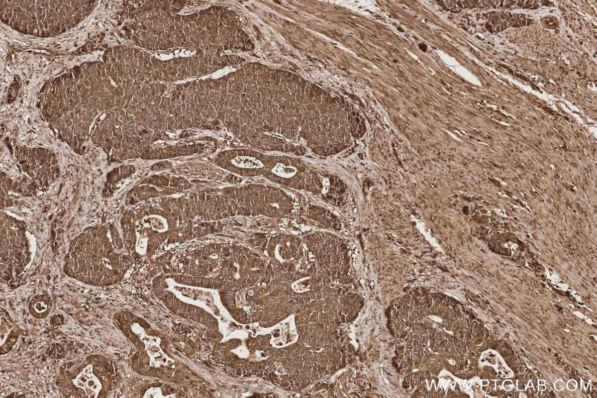 Immunohistochemical analysis of paraffin-embedded human stomach cancer tissue slide using KHC2849 (CCT7 IHC Kit).