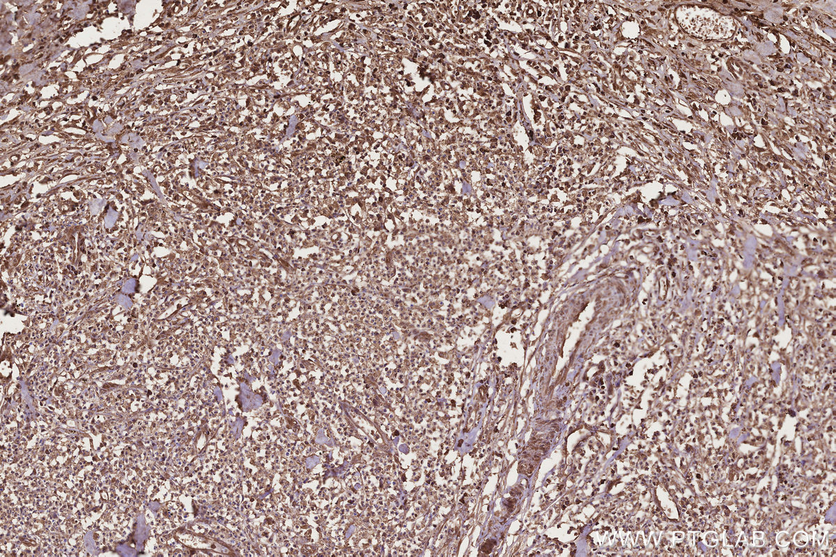 Immunohistochemical analysis of paraffin-embedded human colon cancer tissue slide using KHC3221 (CCT8 IHC Kit). Immunohistochemical analysis of paraffin-embedded human colon cancer tissue slide using KHC3221 (CCT8 IHC Kit).