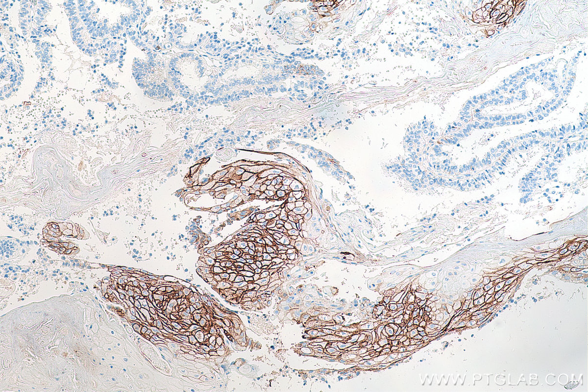 Immunohistochemical analysis of paraffin-embedded human ovary tumor tissue slide using KHC0020 (CD138/Syndecan-1 IHC Kit).
