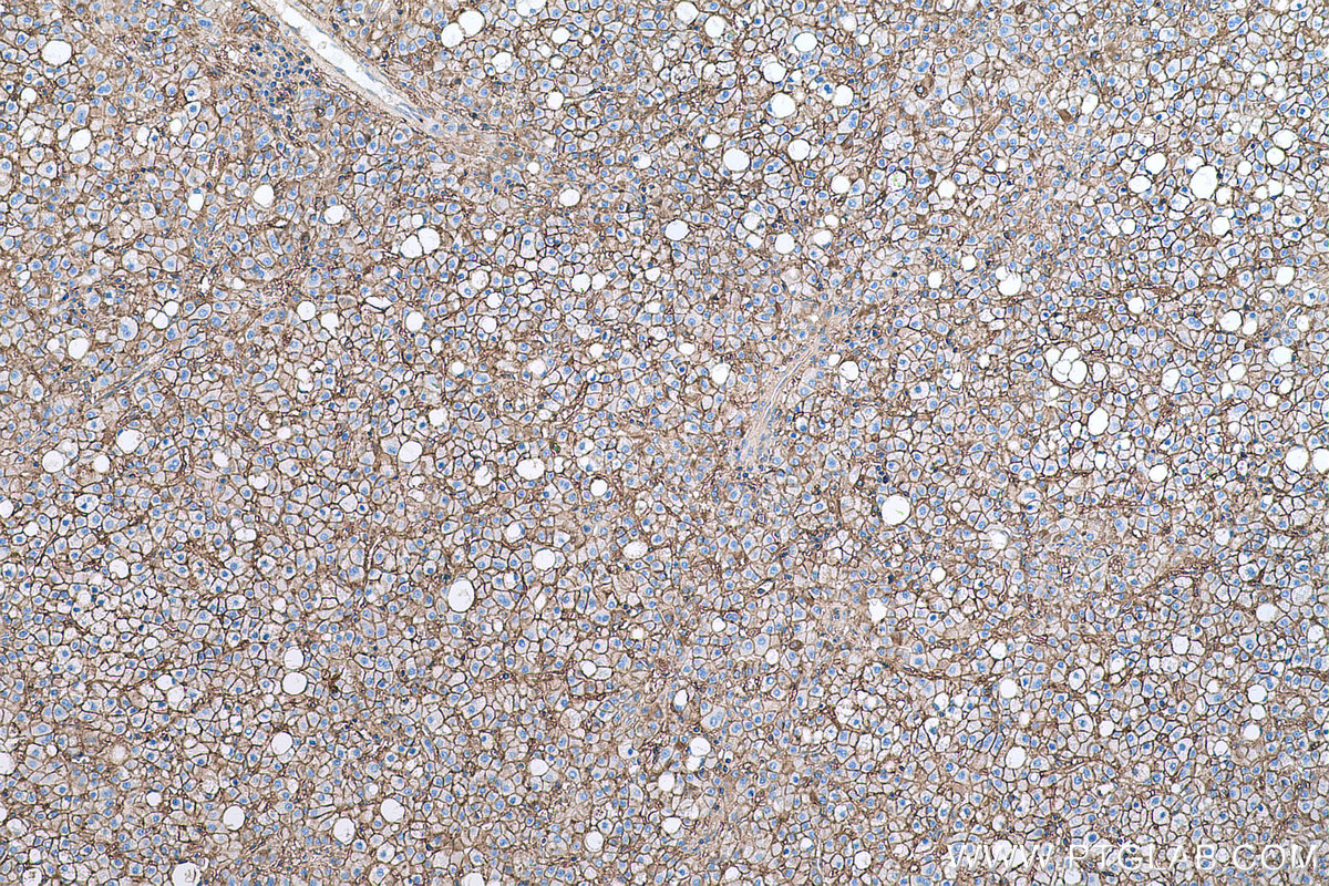 Immunohistochemical analysis of paraffin-embedded human liver cancer tissue slide using KHC0607 (CD147/BSG IHC Kit).