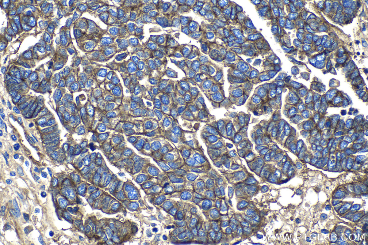 Immunohistochemical analysis of paraffin-embedded human ovary tumor tissue slide using KHC1343 (CD151 IHC Kit).