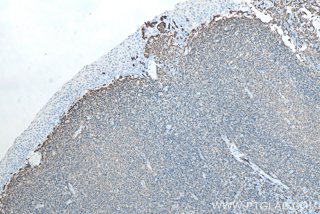 Immunohistochemical analysis of paraffin-embedded human tonsillitis tissue slide using KHC0018 (CD20 IHC Kit).